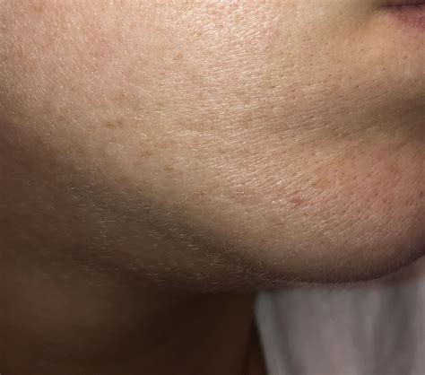 What type of scarring do I have and what treatment would be best for my ...