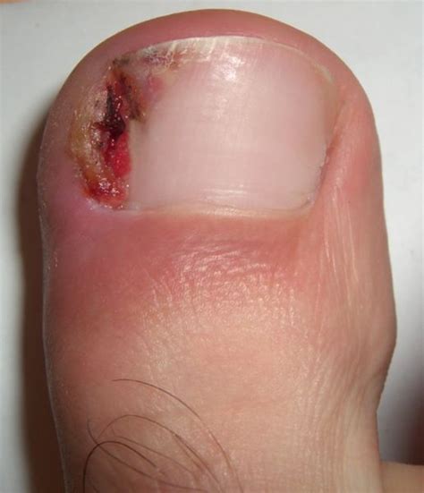 how to know if you have an ingrown nail
