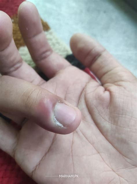 fingernail infection swelling