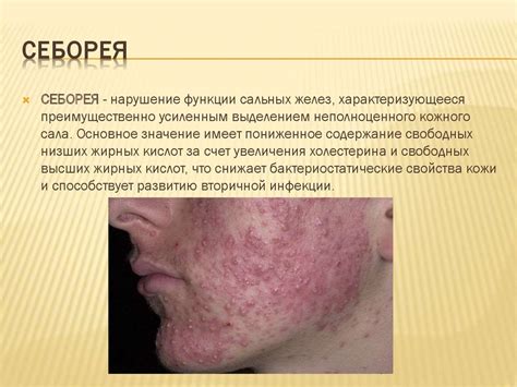 Патогенез себореи - презентация онлайн