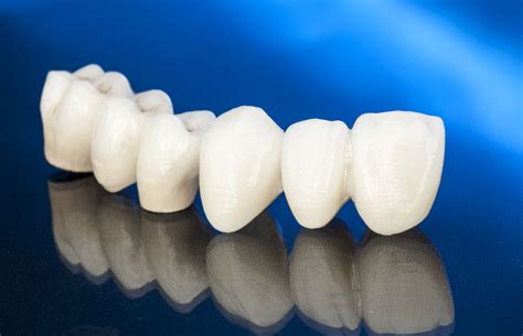 All Ceramic Crowns | London Dental Implant | Dentagama