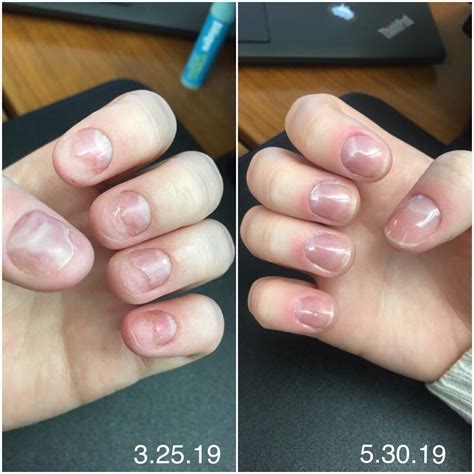 Long term acrylic nails and hypothyroidism damage. I promise you, they ...