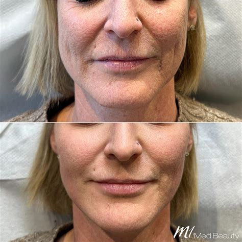 M1 Med Beauty Bulgaria - Твоята 𝗠𝟭 𝗙𝗨𝗟𝗟𝗙𝗔𝗖𝗘 процедура Изживейте своята ...