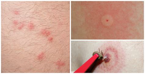 How To Identify The Most Common Bug Bites - Kitchen Fun With My 3 Sons