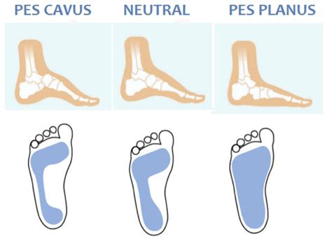 foot type moreland podiatry