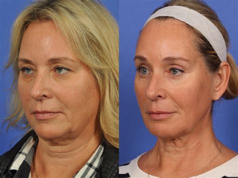 Brow Lift Before & After Photos | W Cosmetic Surgery