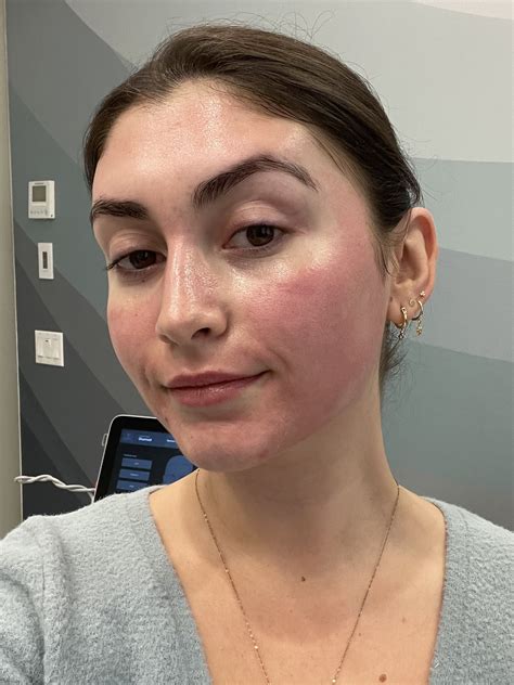 clear brilliant laser treatment review   popsugar beauty uk