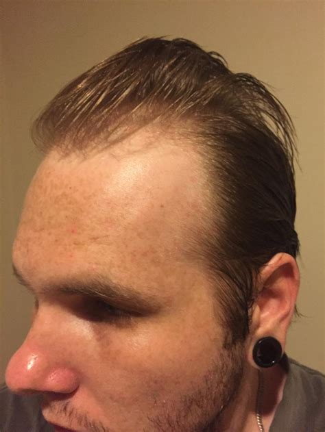 Buzz Cut Thinning Hair