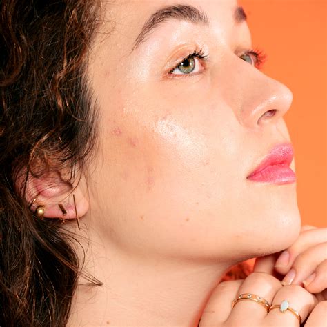 Why Do I Have Pimples Around My Hairline - Infoupdate.org