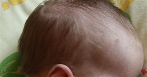 Mellow Mummy: Can a newborn baby catch Chicken Pox? YES! : Taking life ...