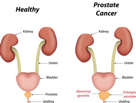 Symptom of prostate cancer