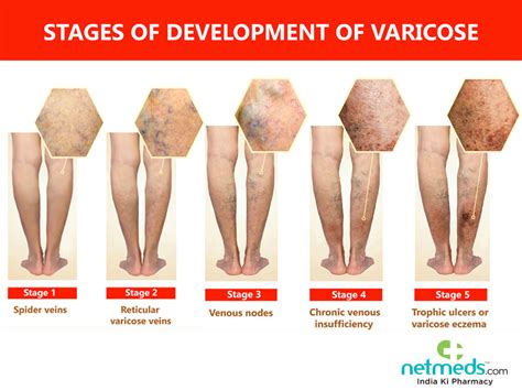 Stages Of Eczema