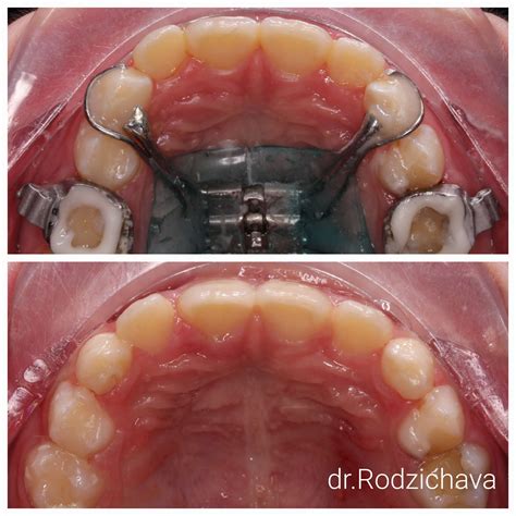 Тесное положение зубов на нижней челюсти | Dentistry