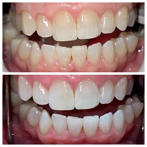 Before & After Dental Results at Relax Dental, Burlington NC