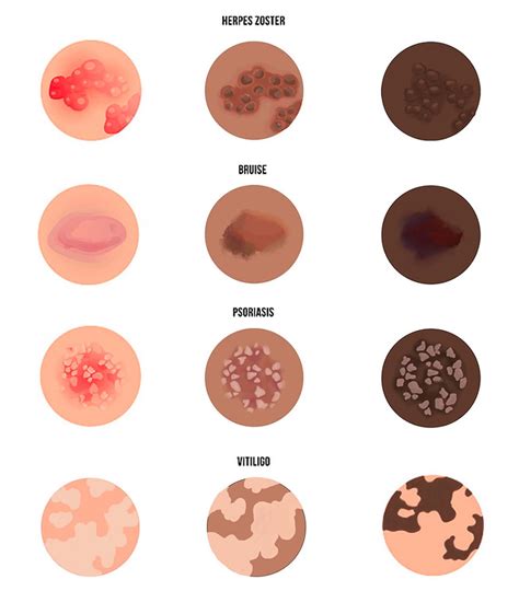 Skin conditions on various skin tones | ArtiniStudio