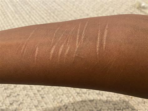 How do I get rid of these scars that are 12 years old? I am willing to
