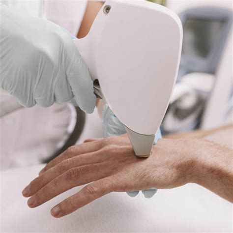 laser hands man skin society