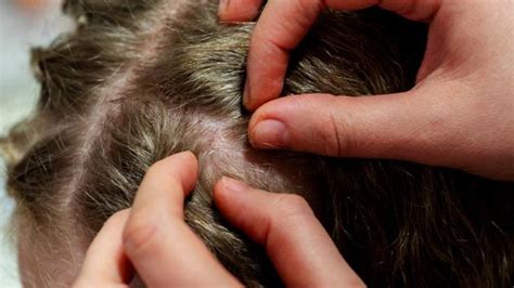 Sonhar Com Piolho E Lêndea - Sonhar com Lêndea: com Piolho, na Cabeça, no Corpo e Saltando