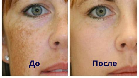 ВЕСНУШКИ и ПИГМЕНТНЫЕ ПЯТНА. Народное средство - Осветляющая маска для ...
