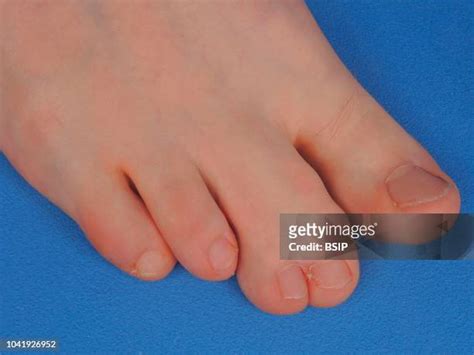 Human Webbed Feet Photos and Premium High Res Pictures - Getty Images