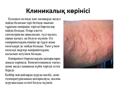 Ауыр аллергиялық реакциялар. Дәрілік аллергия - презентация онлайн