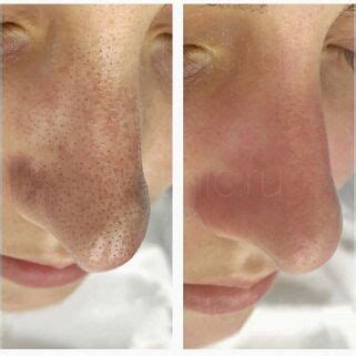 Черные точки на носу | Решение проблем в клинике BeautyWay Clinic