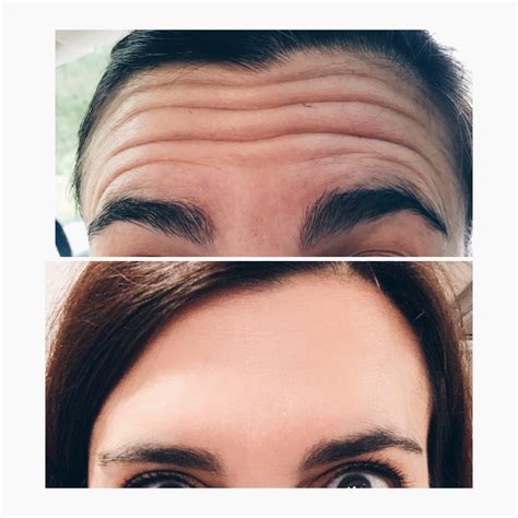 Botox Cosmetic | Find Botox Cosmetic Procedures at the Vascular Experts