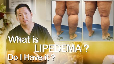 Lipedema Surgery Liposuction | Expert Dr. Thomas Su | ArtLipo - YouTube