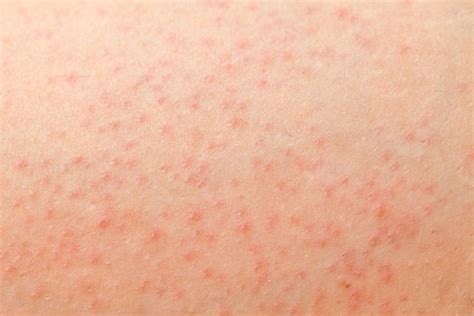 Petechiae: Causes, Symptoms, Treatment & When to Worry - Tua Saúde