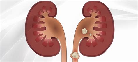 O Que É Ureterolitíase