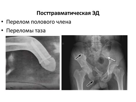 Эректильная дисфункция - online presentation