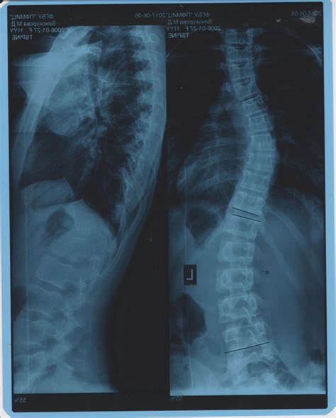 Сколиоз 3 ст.: ru_scoliosis — LiveJournal