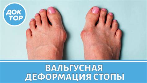 Причины возникновения Халюс Вальгус - YouTube