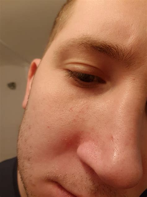 Are these bright red dots under the eyes acne? : r/acne