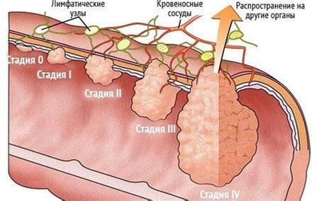 МРТ при раке прямой кишки покажет ли томография онкологию прямой кишки