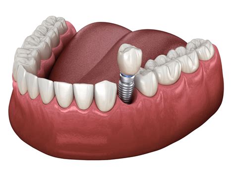 Dental Implants — Captain Dental