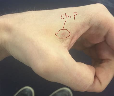 I got a computer chip implanted into my hand. Here’s how it went. | Vox