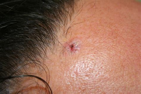 Stage 4 Basal Cell Carcinoma