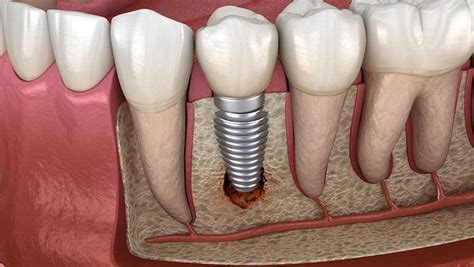 Bone Grafts - Periodontist Wilmington