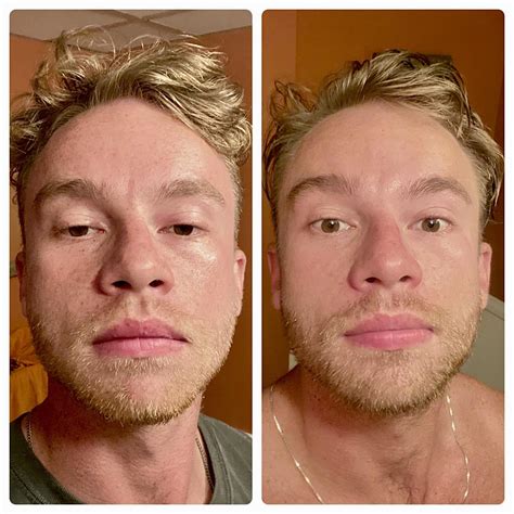 beforeafter   months    tret nightly cerave