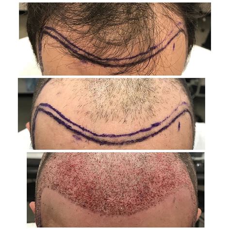 Christopher Varona on Instagram: “🎉 3180 manual FUE grafts placed to ...
