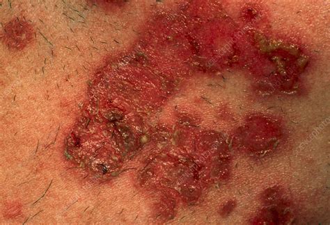 skin rash staph infection  mark ferretti blog