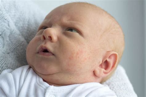 Causas de la urticaria en los bebés