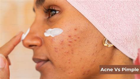 acne  pimples key differences    matter