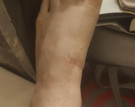 EHL Tendon Laceration (Healing Progression) : r/InjuriesAndWounds