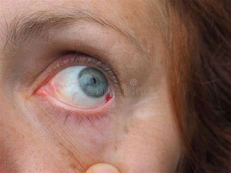Subconjunctival Hemorrhage or Subconjunctival Bleeding, Hyposhagmus ...