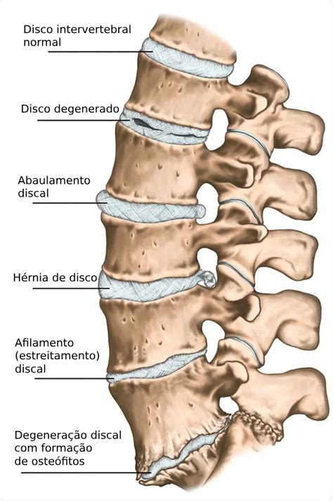O Que É Discopatia Lombar