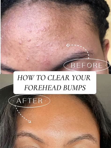 ways  treat  fungal acne gallery posted  ellie