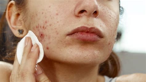 Acne Treatment: A Complete Guide (With Images) - GoodRx