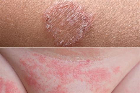 fungal skin rash skin fungal infections symptoms types